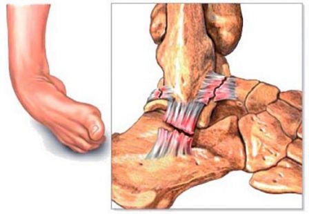 entorse.jpg